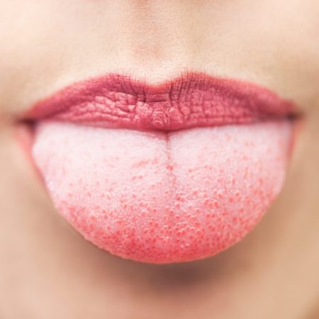 زبان سفید و ارتباط آن با سلامت بدن: علل، علائم و راه‌ های درمان