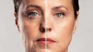 عوامل موثر در ایجاد چین و چروک صورت و روش‌ های پیشگیری