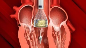 تحولی تاریخی در علم پزشکی: تعویض دریچه قلب بدون نیاز به باز کردن قفسه سینه