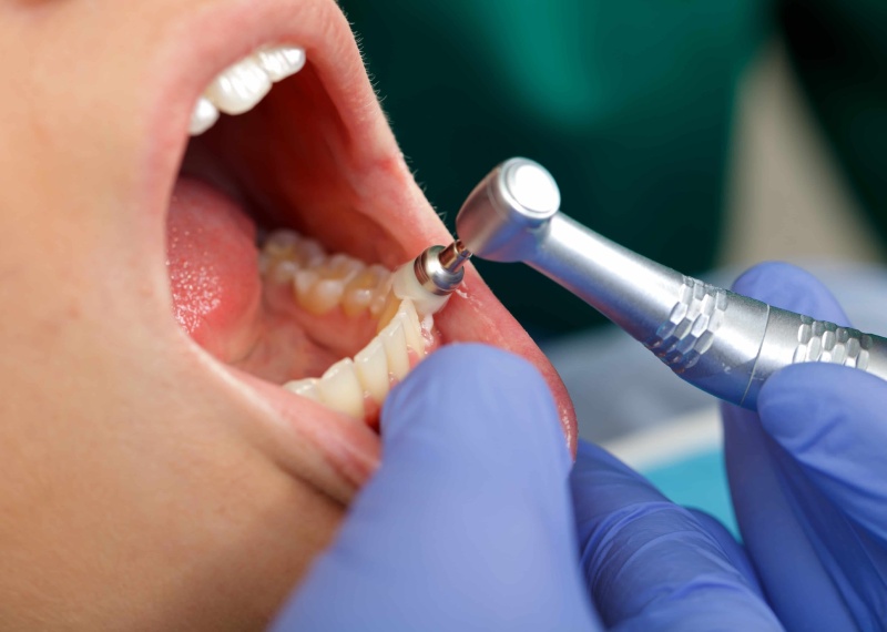 نکات حیاتی درباره جرم و جرم‌ گیری دندان‌ ها: هر آنچه باید بدانید