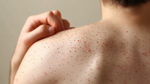 هشدار درباره شیوع سرخک در شمال کشور