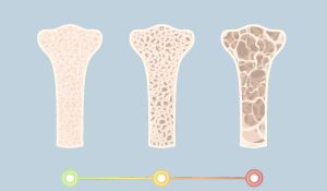 پوکی استخوان؛ بیماری خاموش اما شایع که باید جدی گرفته شود