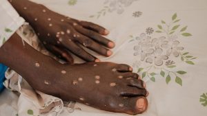 آبله میمونی دیگر یک وضعیت اضطراری بهداشت جهانی محسوب نمی‌ شود