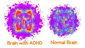 ساختار مغز افراد مبتلا به ADHD چگونه با دیگران تفاوت دارد؟