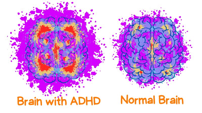 ساختار مغز افراد مبتلا به ADHD چگونه با دیگران تفاوت دارد؟
