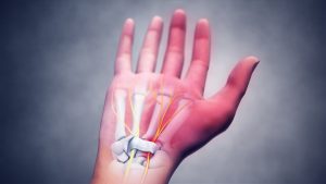 سندروم تونل کارپال: علائم، علل و راهکارهای پیشگیری و درمان با تمرینات ساده