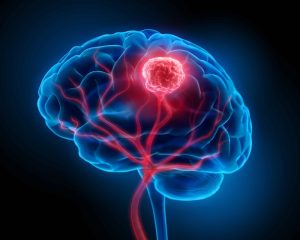 پیشرفت‌ های نوین در درمان تومور مغزی با استفاده از فناوری صوتی