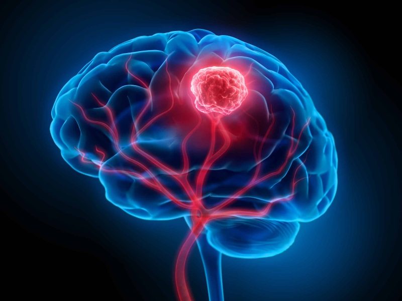 پیشرفت‌ های نوین در درمان تومور مغزی با استفاده از فناوری صوتی