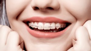 اهمیت رعایت بهداشت دهان و دندان در بیماران ارتودنس