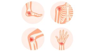 علائم پنهان آرتریت روماتوئید: شناسایی زود هنگام از طریق خون قبل از بروز درد مفصلی