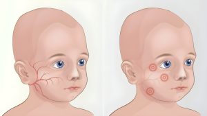 مغز کودکان مبتلا به PKU چگونه تحت تأثیر رژیم غذایی قرار می‌ گیرد