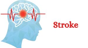 چگونه سکته مغزی را تشخیص دهیم؟ راهنمای جامع شناسایی و اقدام سریع