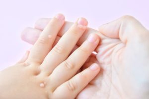 زگیل‌ های دوران کودکی؛ از علل تا پیشگیری و درمان