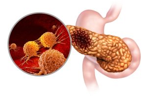 شناسایی علامت هشدار دهنده اولیه سرطان پانکراس