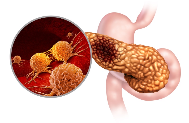 شناسایی علامت هشدار دهنده اولیه سرطان پانکراس
