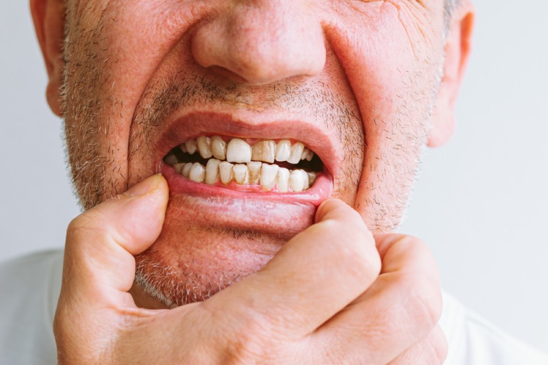 چرا مردان بیشتر در معرض پوسیدگی دندان و بیماری لثه قرار می‌ گیرند؟