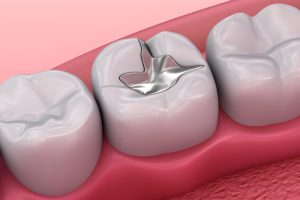 آمالگام دندانپزشکی و بررسی خطرات آن + نکات مهم برای سلامت دهان و دندان