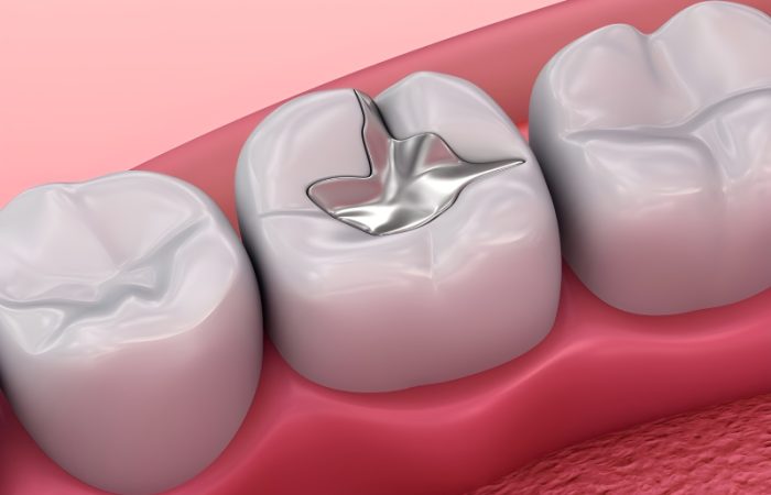 آمالگام دندانپزشکی و بررسی خطرات آن + نکات مهم برای سلامت دهان و دندان