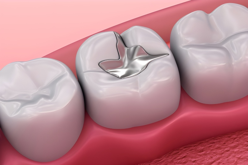 آمالگام دندانپزشکی و بررسی خطرات آن + نکات مهم برای سلامت دهان و دندان