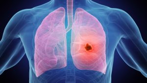 سرطان ریه بیماری خاموش و مرگبار