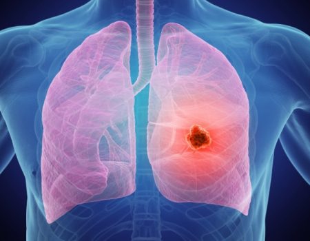 سرطان ریه بیماری خاموش و مرگبار