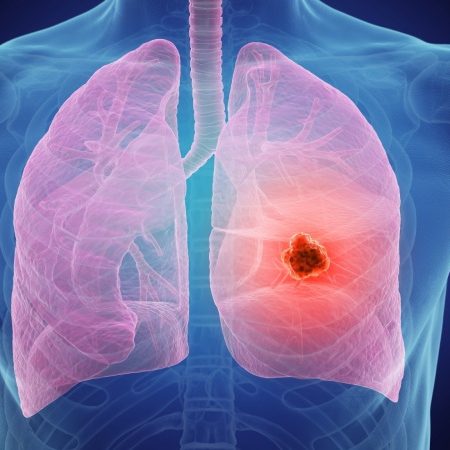 سرطان ریه بیماری خاموش و مرگبار
