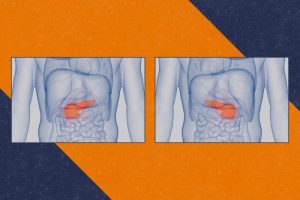 تحول در درمان دیابت؛ ایمپلنت زیستی که عملکرد لوزالمعده را شبیه سازی می کند