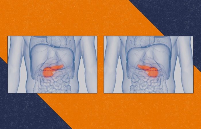 تحول در درمان دیابت؛ ایمپلنت زیستی که عملکرد لوزالمعده را شبیه سازی می کند