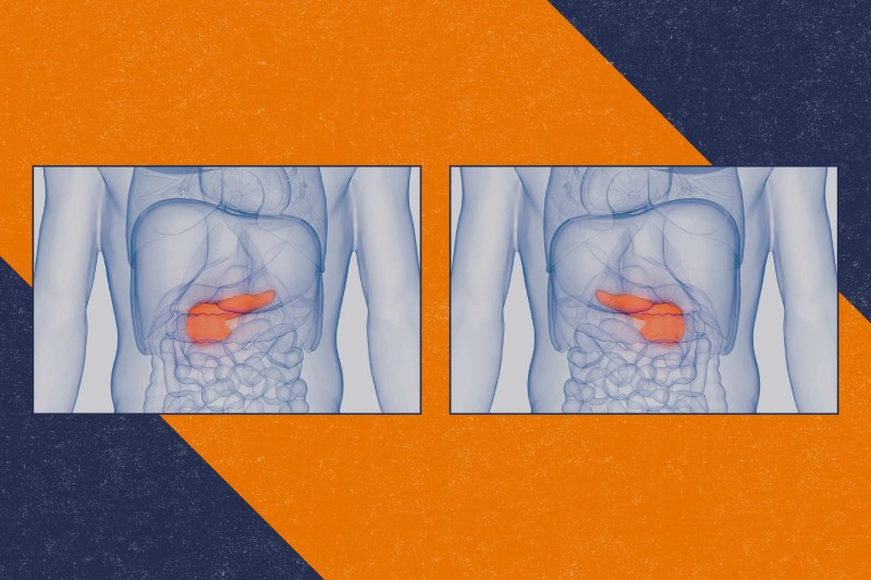 تحول در درمان دیابت؛ ایمپلنت زیستی که عملکرد لوزالمعده را شبیه سازی می کند