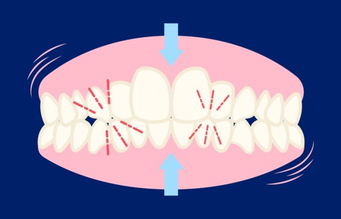 ۳ علامت پنهان دندان‌ قروچه و روش‌ های مؤثر درمان آن