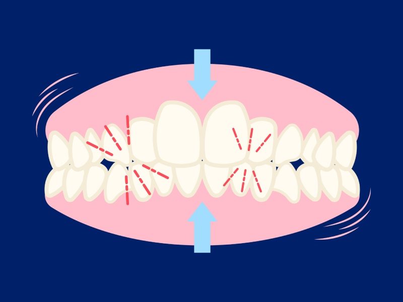 ۳ علامت پنهان دندان‌ قروچه و روش‌ های مؤثر درمان آن