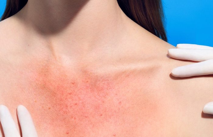 مسمومیت با آفتاب چیست؟ علائم هشدار دهنده، روش های درمان و زمان مراجعه به پزشک