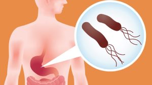 هلیکوباکتر پیلوری چگونه خطر سرطان معده را افزایش می دهد؟