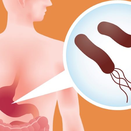 هلیکوباکتر پیلوری چگونه خطر سرطان معده را افزایش می دهد؟