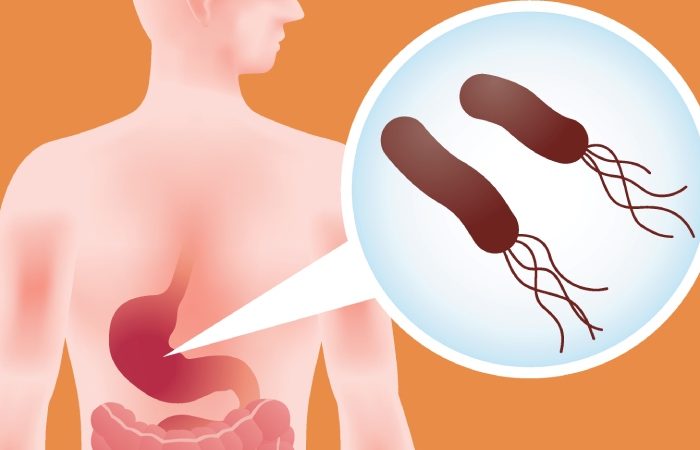 هلیکوباکتر پیلوری چگونه خطر سرطان معده را افزایش می دهد؟