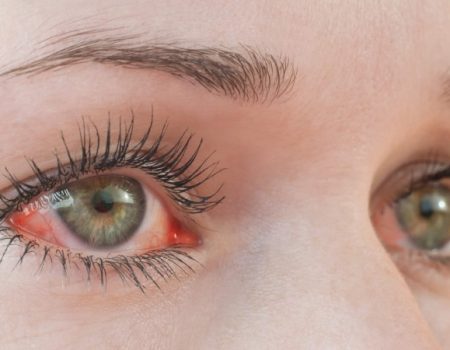 قرمزی ناگهانی چشم نشانه چیست؟ علت پارگی رگ چشم و روش درمان آن