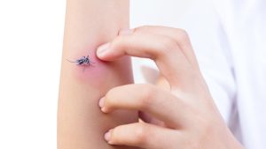 چرا نباید جای نیش حشرات را بخارانیم؟ دلیل علمی تشدید خارش و التهاب پوست
