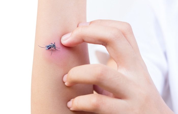 چرا نباید جای نیش حشرات را بخارانیم؟ دلیل علمی تشدید خارش و التهاب پوست